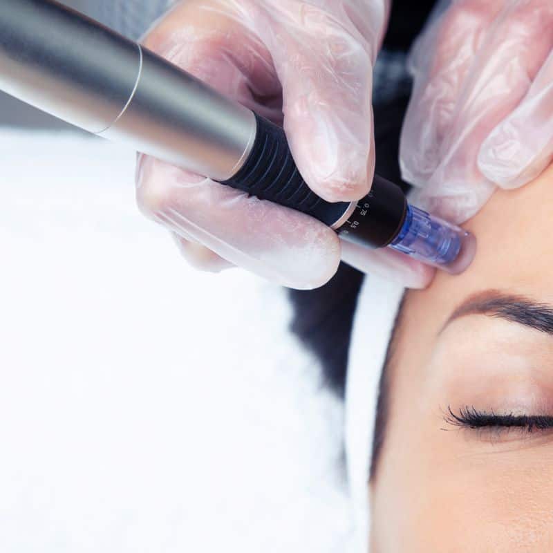 Morpheus8 treatment Amesbury from Lipo Sculpt - Book in today!